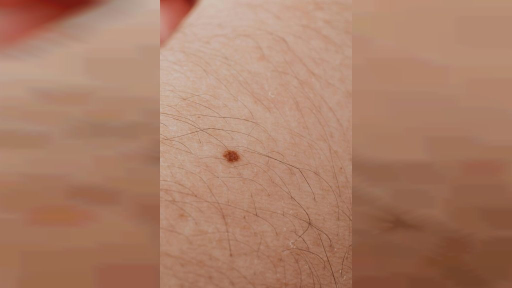 BESPLATNI PREGLED KOD DERMATOLOGA BEZ KNJIŽICE U ALIBUNARU Obezbeđen i prevoz za meštane okolnih sela
